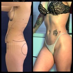 Liposucción - Dr. Francisco Zambrano