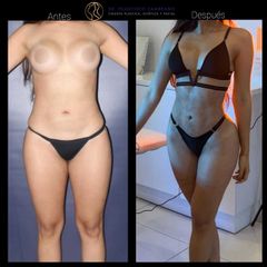 Liposucción - Dr. Francisco Zambrano