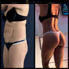 Liposucción - Dr. Francisco Zambrano