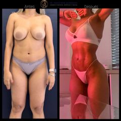 Liposucción - Dr. Francisco Zambrano