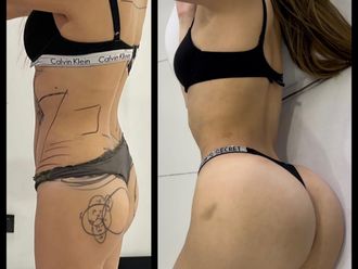 Lipoescultura antes y después - 880801