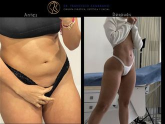 Lipoescultura antes y después - 880818