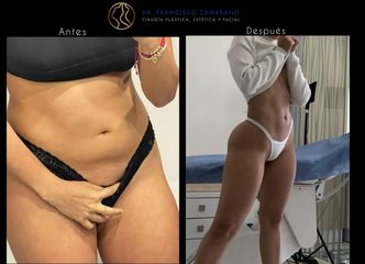 Lipoescultura - Dr. Francisco Zambrano