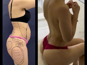 Lipoescultura antes y después - 880820