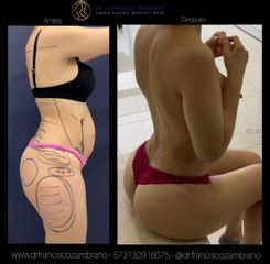 Lipoescultura - Dr. Francisco Zambrano