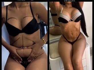 Liposucción antes y después - 880822
