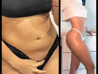 Abdominoplastia antes y después - 880824