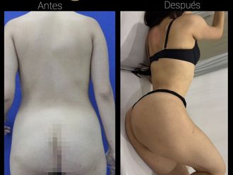 Liposucción antes y después - 880825