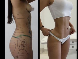 Lipoescultura antes y después - 880826