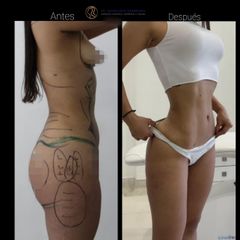 Lipoescultura - Dr. Francisco Zambrano