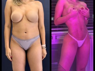 Lipoescultura antes y después - 880827