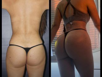 Gluteoplastia antes y después - 880829
