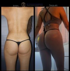 Gluteoplastia - Dr. Francisco Zambrano