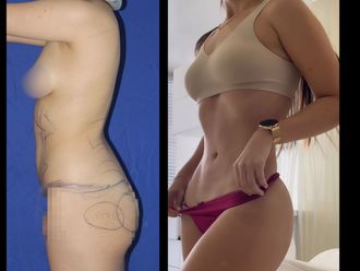Lipoescultura antes y después - 880830