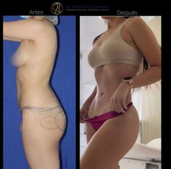 Lipoescultura