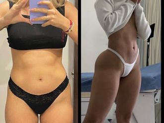 Abdominoplastia antes y después - 880832