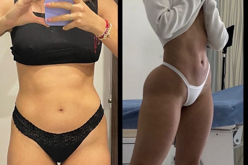 Abdominoplastia antes y después - 880832