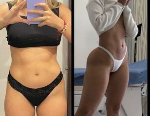 Abdominoplastia - Dr. Francisco Zambrano