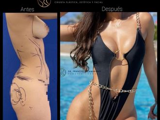 Lipoescultura antes y después - 880833