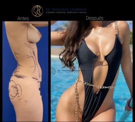 Lipoescultura - Dr. Francisco Zambrano