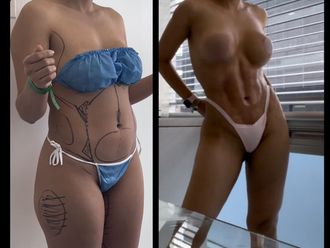 Liposucción antes y después - 880834