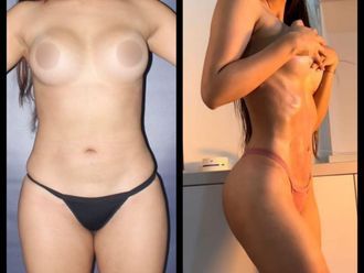 Lipoescultura antes y después - 880835