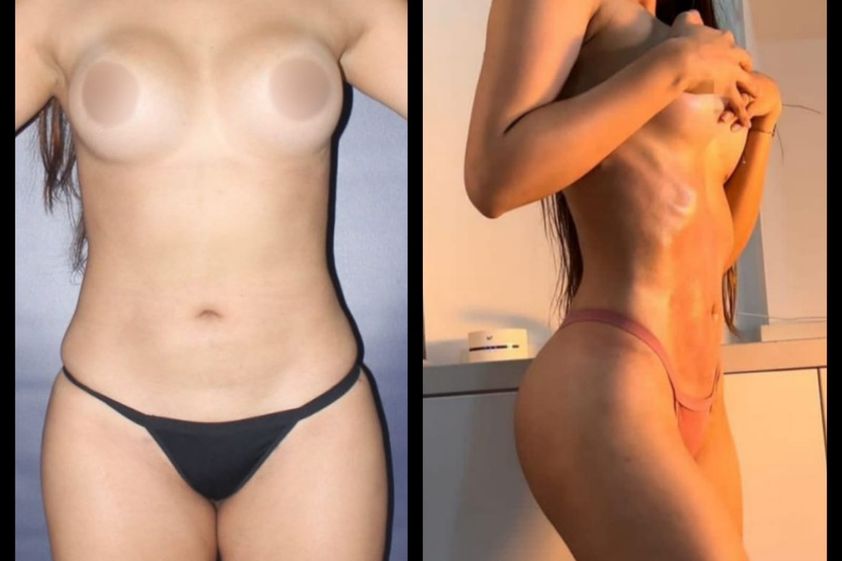Lipoescultura antes y después - 880835