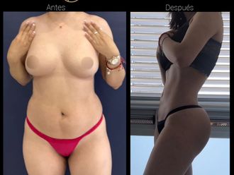 Liposucción antes y después - 880836