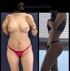 Liposucción - Dr. Francisco Zambrano