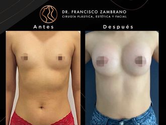 Mamoplastia de aumento antes y después - 881294
