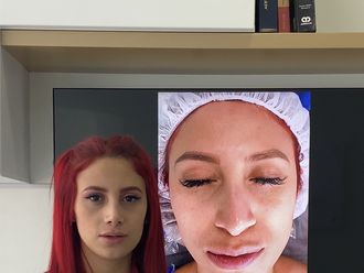 Rinoplastia antes y después - 881297