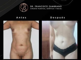 Abdominoplastia antes y después - 881298