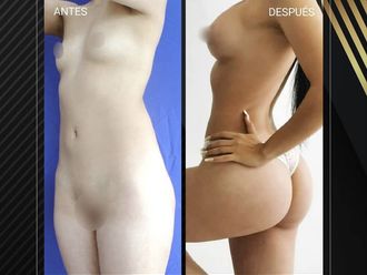 Lipoescultura antes y después - 881299
