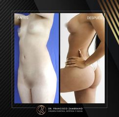 Lipoescultura - Dr. Francisco Zambrano