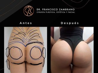 Gluteoplastia antes y después - 881300