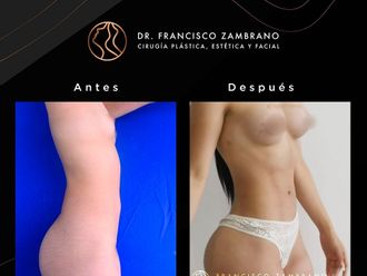 Lipoescultura antes y después - 881301