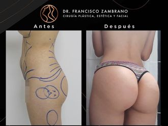 Gluteoplastia antes y después - 881302