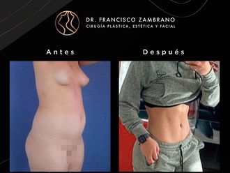 Liposucción antes y después - 881303