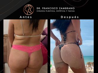 Gluteoplastia antes y después - 881304