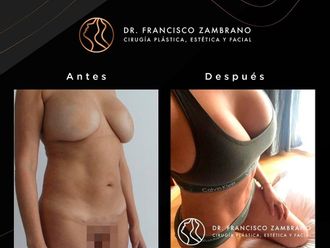Lipoescultura antes y después - 881305