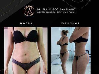 Liposucción antes y después - 881306
