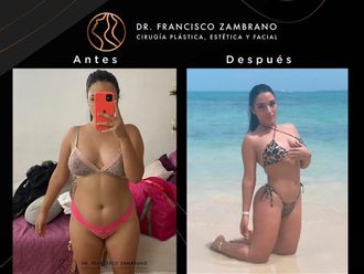 Liposucción antes y después - 881307