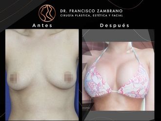 Mamoplastia de aumento antes y después - 881308