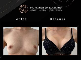 Mamoplastia de aumento antes y después - 881309