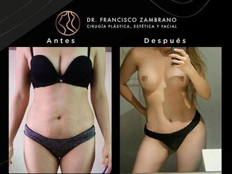 Liposucción antes y después - 881310