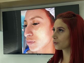 Rinoplastia antes y después - 881311