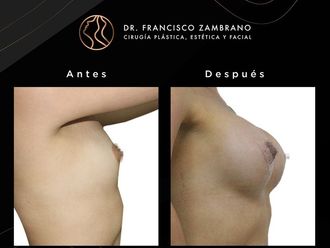 Mamoplastia de aumento antes y después - 881312