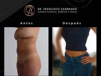 Liposucción antes y después - 881313