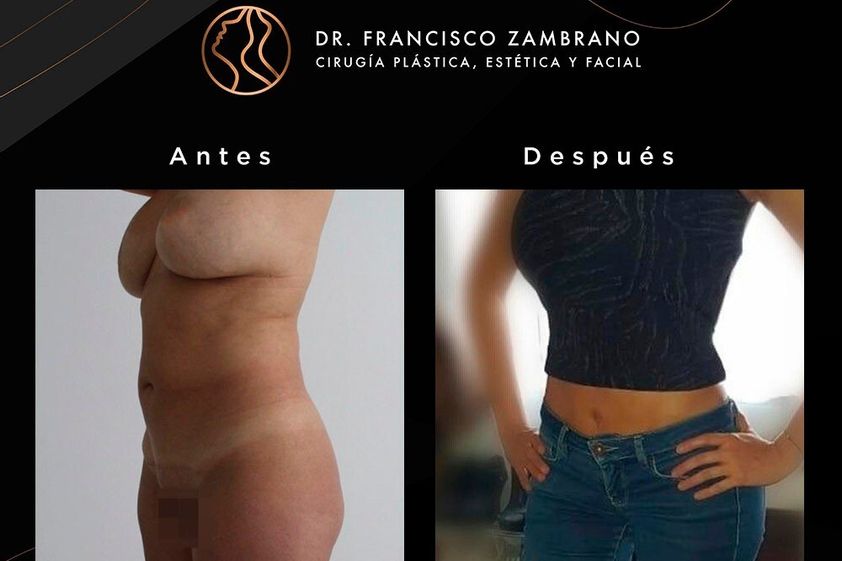 Liposucción antes y después - 881313