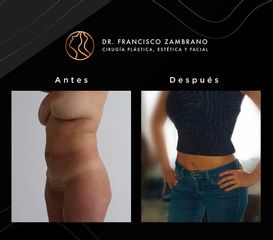 Liposucción - Dr. Francisco Zambrano